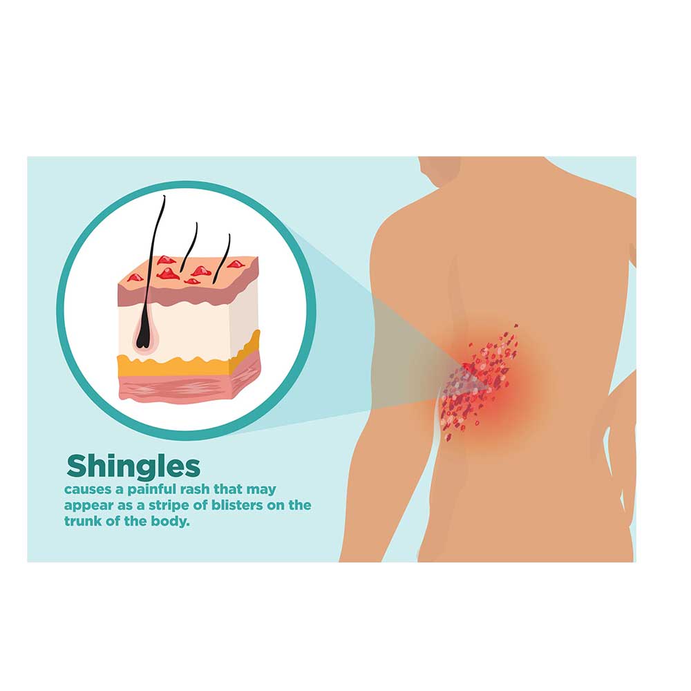 Shingles zoster virus