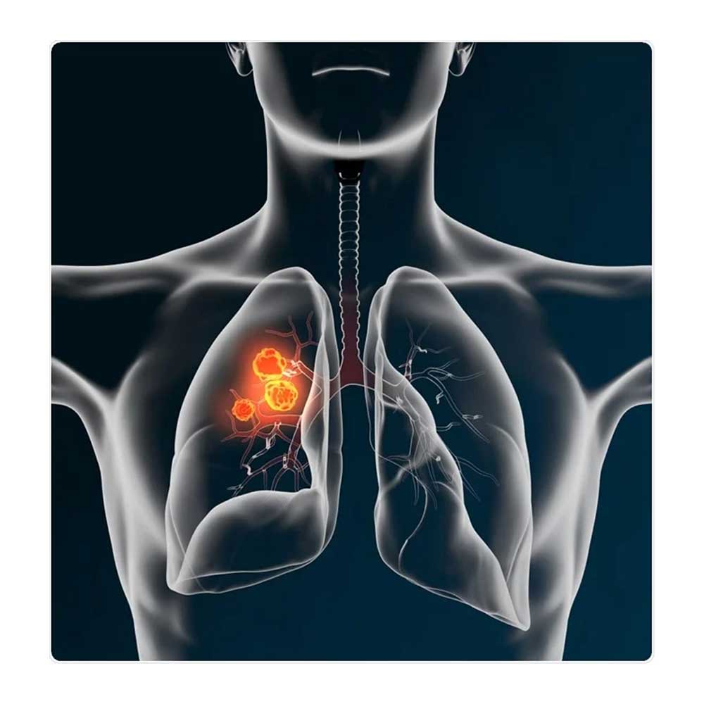 Gefitinib: A Beacon of Hope in the Fight Against Lung Cancer for Mumbai Residents