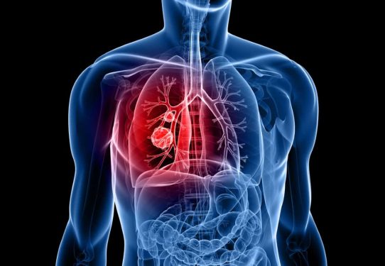 Lung Cancer