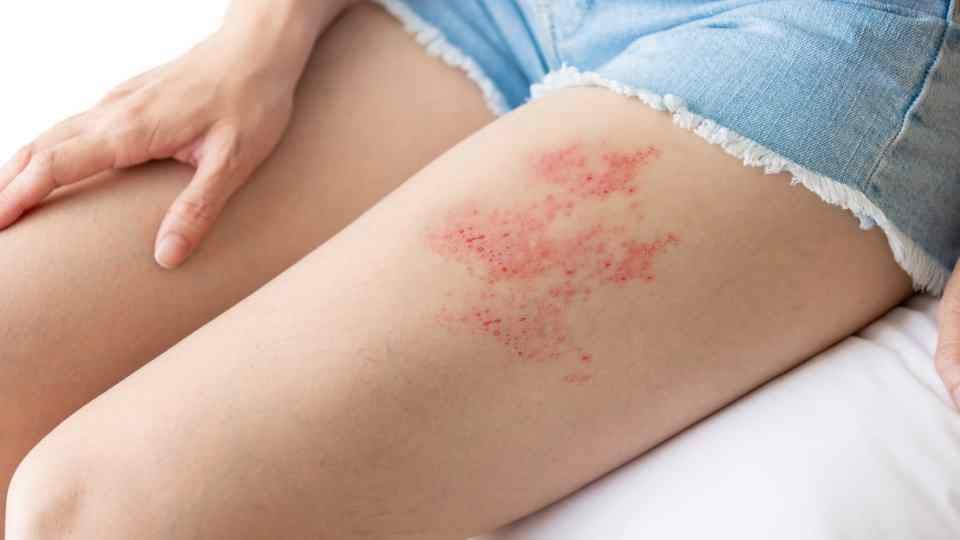 Shingles